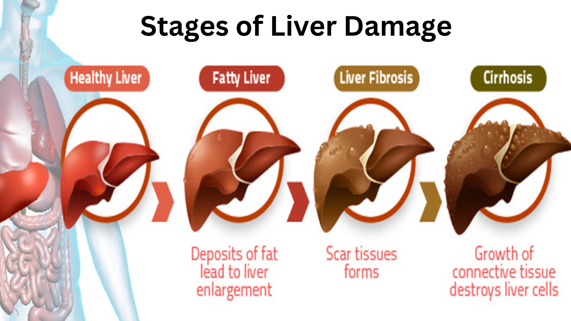 5 Stages of Liver Damage